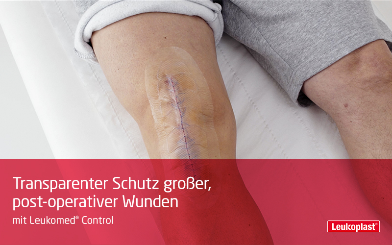 Dieses Video zeigt die Versorgung post-operativer Wunden mit Leukomed® Control: Das Fachpersonal deckt die chirurgische Inzision am Knie des Patienten ab. Dieses Video zeigt die Versorgung post-operativer Wunden mit Leukomed® Control: Das Fachpersonal deckt die chirurgische Inzision am Knie des Patienten ab.